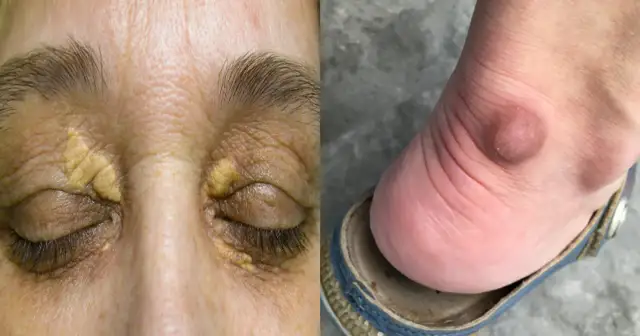 Jakie są objawy wysokiego cholesterolu i kiedy mogą być groźne?