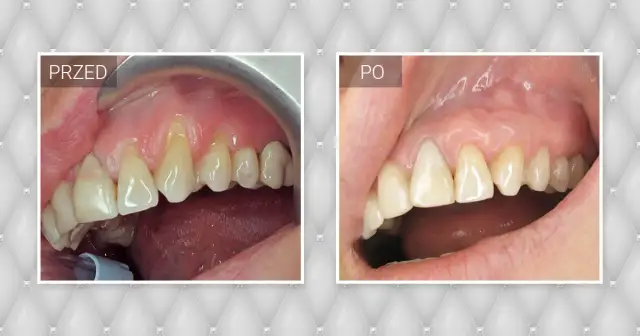 Czy dziąsła odrosną? Odbudowa, leczenie recesji i koszty.