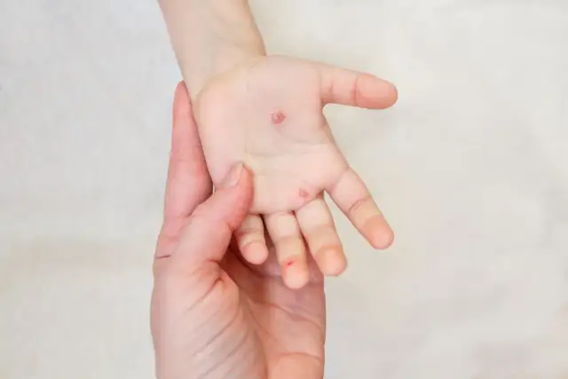 Ospa u dziecka: Bezpieczne leczenie, ulga od świądu i gorączki