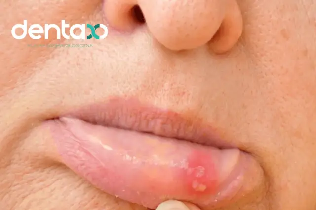 Afty na dziąśle: Szybka ulga i skuteczne metody leczenia