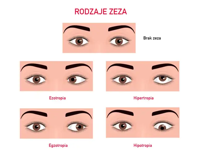 Zez ukryty u dziecka objawy: jak je rozpoznać i kiedy działać