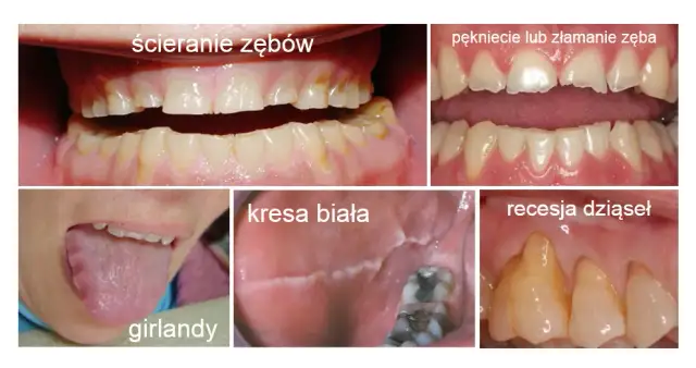 Płacz i zgrzytanie zębów: Czy bruksizm niszczy Twoje zęby?