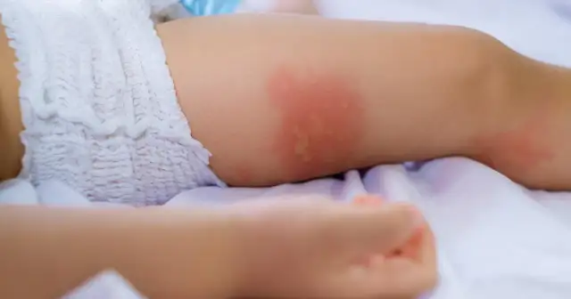 Wysypka u dziecka bez gorączki: Spokój czy pilna wizyta u lekarza?