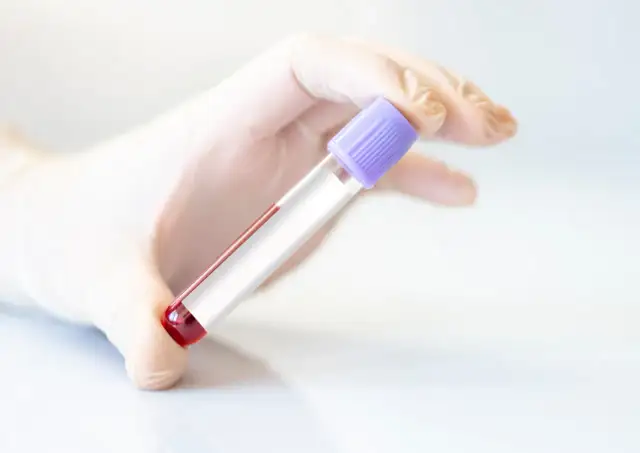 Jakie badania krwi na prostatę? PSA, normy, co dalej?