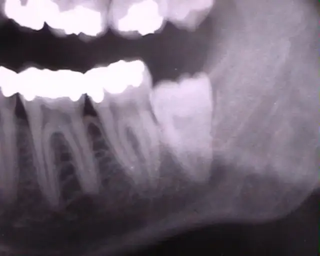 Czy ząb mądrości sam wypada? Poznaj przyczyny i objawy wypadania