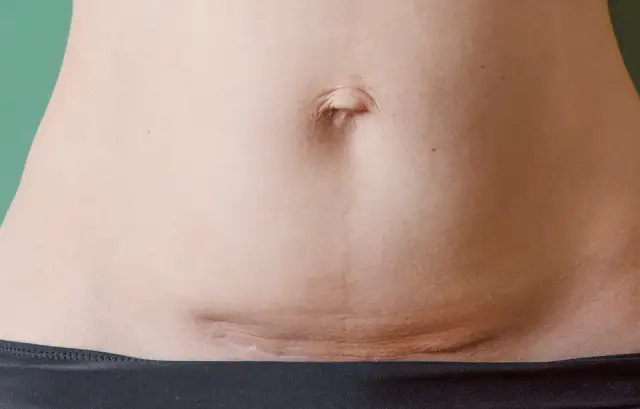 Jak wygląda blizna po cesarce? Co warto wiedzieć o jej wyglądzie