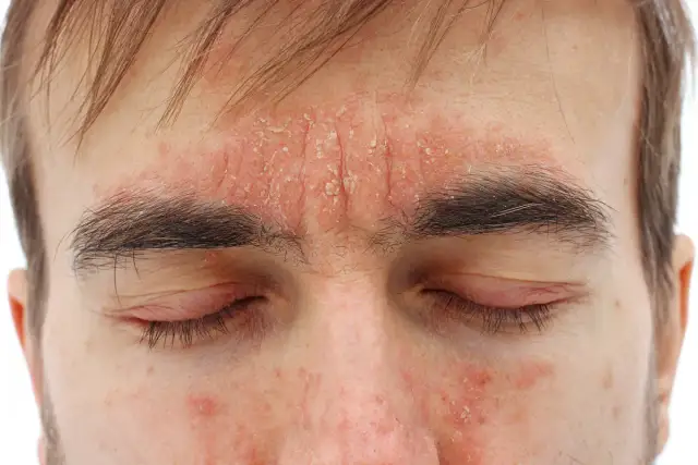 Nahaufnahme eines Gesichts mit roten, schuppigen Hautstellen auf Stirn und Wangen.