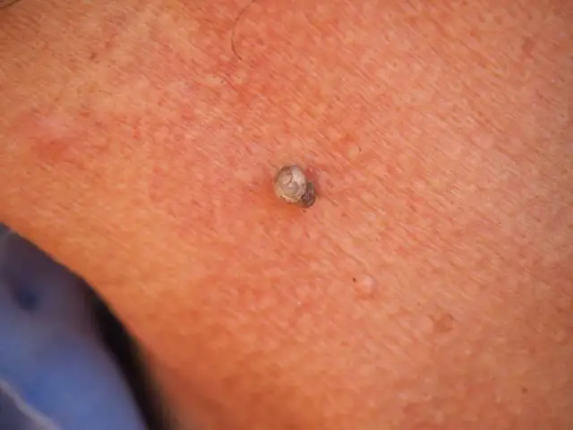 Pryszcz jak guz - rozpoznaj i leczyj podskórne zmiany skórne