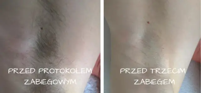 Ile zabiegów depilacji SHR potrzebujesz dla trwałych efektów?