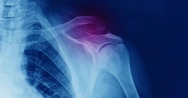 Złamany obojczyk: Ile trwa gojenie i powrót do zdrowia?