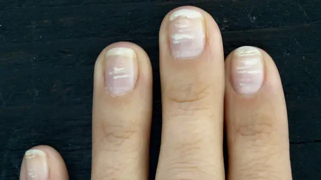 Rak paznokcia objawy: Jak rozpoznać niebezpieczne zmiany na paznokciach