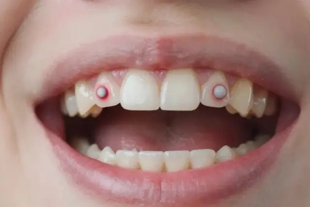 Afta na dziąśle: przyczyny, objawy i kiedy iść do lekarza?