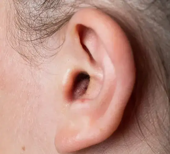 Pryszcz podskórny: Jak się pozbyć? Domowe sposoby i apteczne hity