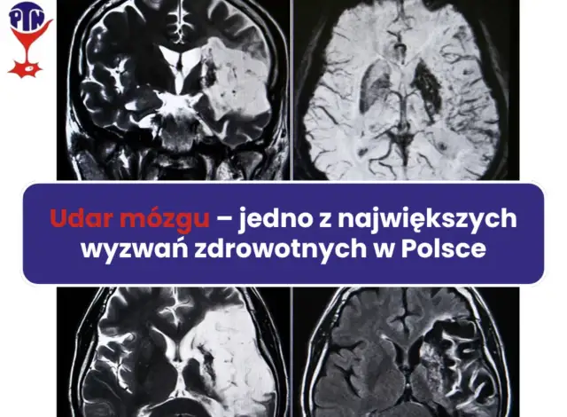 Udar mózgu: Czy umiera się? Kluczowe fakty i nadzieja na życie.