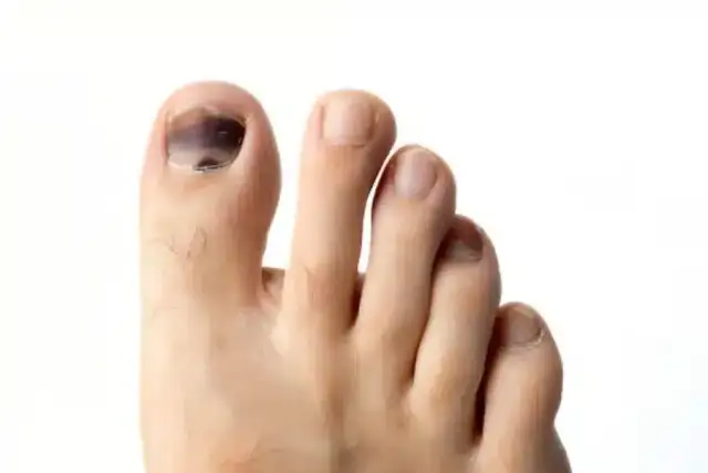 Jak schodzi paznokieć po uderzeniu? Objawy, leczenie i regeneracja