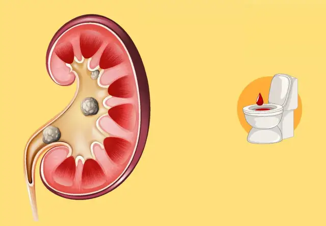 Krew w moczu: Czy to rak? Przyczyny i pilna diagnostyka.