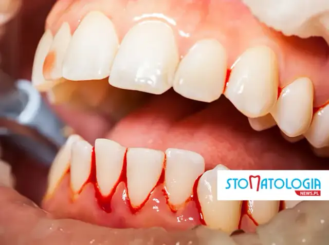 Krwawiące dziąsła? Zatamuj krwotok w domu! Kiedy do dentysty?
