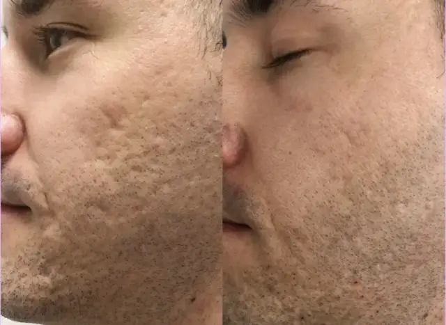 Laser frakcyjny nieablacyjny: Czy to najlepsza inwestycja w skórę?