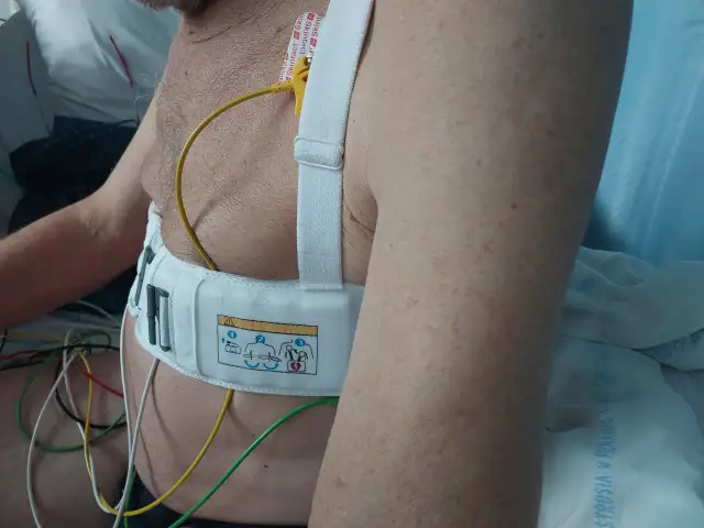 Pacjent z kardiowerterem-defibrylatorem wszczepionym pod skórę, z widocznymi elektrodami i przewodami.