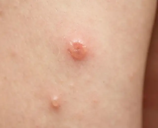 Guzek w pachwinie do jakiego lekarza? Poznaj ważne informacje zdrowotne