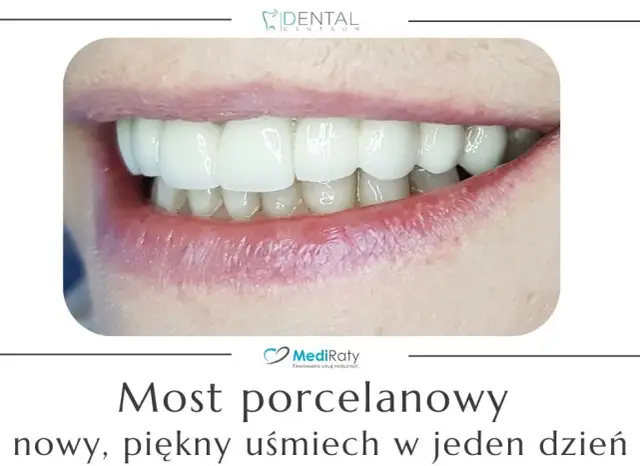 Mostek na zębach: Zobacz, jak wygląda i odzyskaj uśmiech!