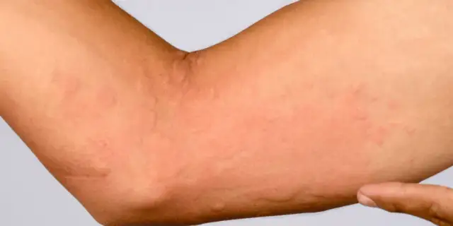 Czy brzoza uczula? Objawy alergii i jak ich unikać w sezonie pylenia