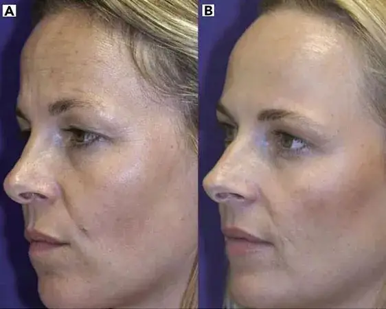 Nieudany botoks? Przyspiesz zanikanie i koryguj efekty