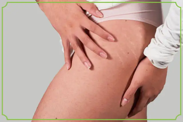 Jak zapobiec rozstępom? Skuteczne metody na zdrową skórę