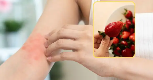 Czy to uczulenie na truskawki? Rozpoznaj objawy i dowiedz się, co robić
