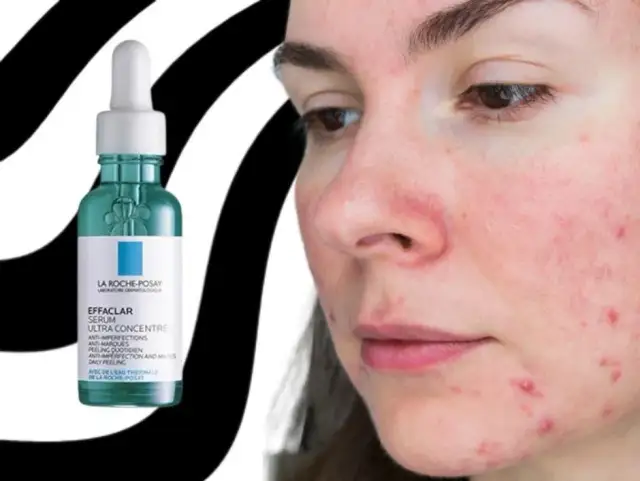 Serum na niedoskonałości: Jak wybrać idealne i pożegnać trądzik?