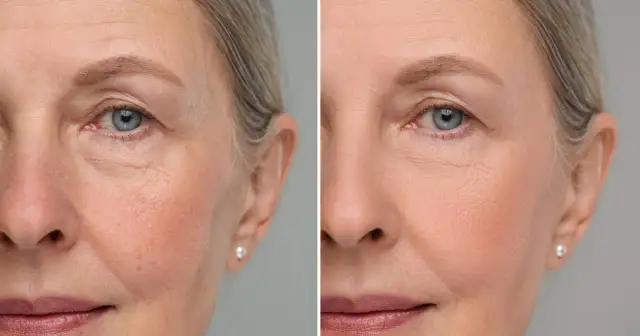 Porównanie skóry przed i po zabiegu. Widoczne wygładzenie zmarszczek, poprawa kolorytu. Czy to zasługa pullulan co to jest?