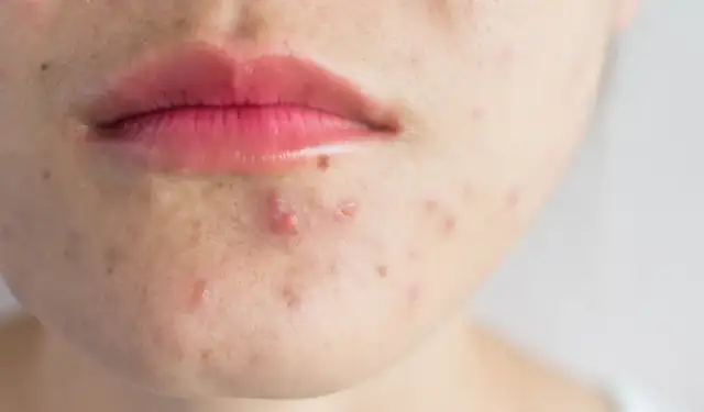 Jak szybko pozbyć się strupa po pryszczu? Skuteczne metody