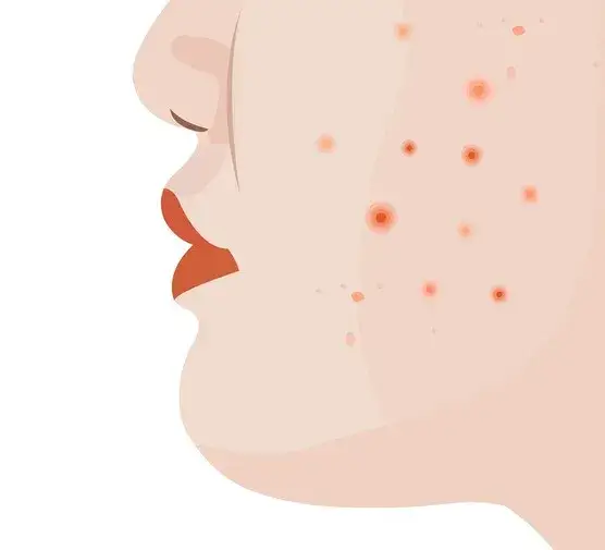 Co oznaczają pryszcze na brodzie? Przyczyny i skutki, które musisz znać