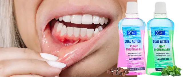 Krwawiące dziąsła: Skuteczne sposoby i leczenie | Poznaj przyczyny