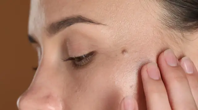 Zbliżenie na twarz z widocznym pieprzykiem, sugerujące rozważania o usuwaniu pieprzyków z twarzy.