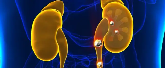 Czy badanie moczu wykryje kamicę nerkową? Co warto wiedzieć?