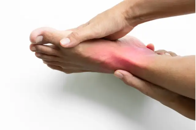 Jak skutecznie leczyć skręcenie śródstopia i uniknąć powikłań