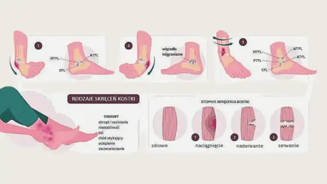 Jak skręcić nogę i uniknąć poważnych konsekwencji zdrowotnych