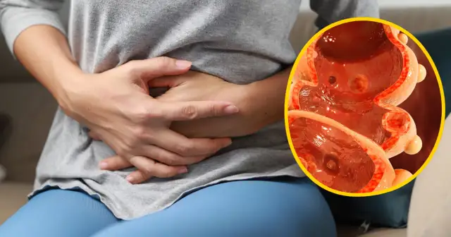 Jak boli brzuch przy raku jelita grubego? Objawy, które musisz znać