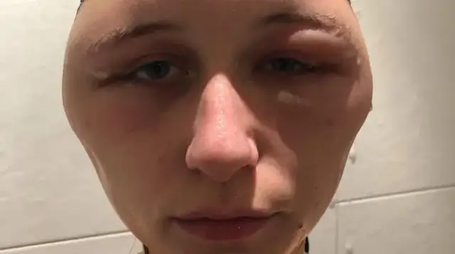 Alergia na farby do włosów objawy - jak uniknąć niebezpiecznych reakcji