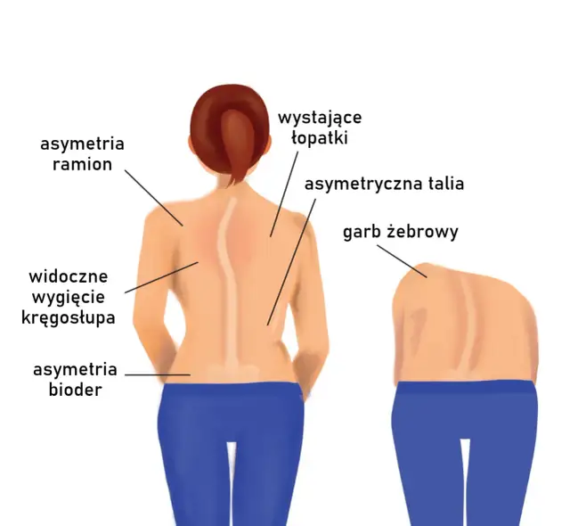 Skolioza u dorosłych objawy: Jak rozpoznać i uniknąć powikłań