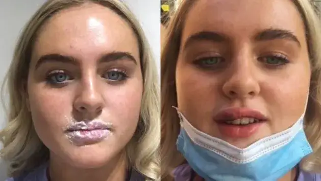 Alkohol po kwasie hialuronowym? Dlaczego to błąd i co tracisz?