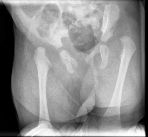 Skręcenie stawu biodrowego: objawy, pierwsza pomoc i leczenie