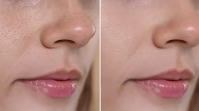 Jak pozbyć się pryszcza, który jeszcze nie wyszedł, zanim się pojawi