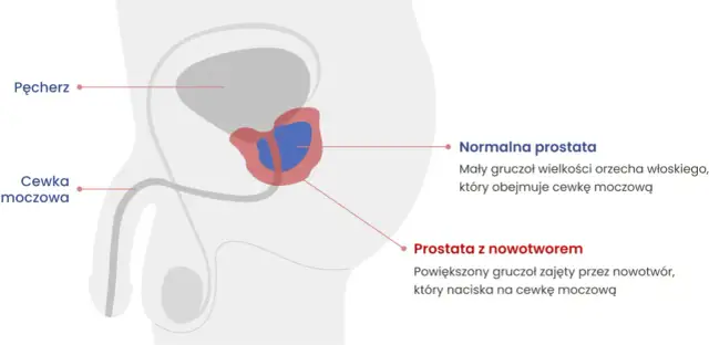 Choroba prostaty objawy – jak je rozpoznać i uniknąć poważnych problemów