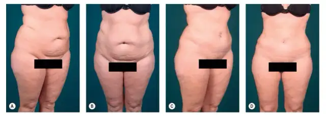 Plastyka brzucha nfz gdzie? Sprawdź, jak uzyskać refundację i pomoc