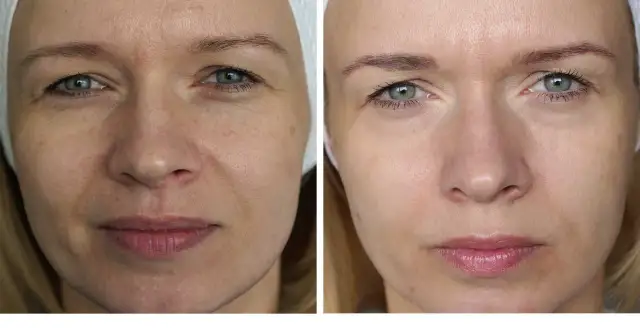 Laser frakcyjny: Na co pomaga? Efekty, wskazania i wybór lasera