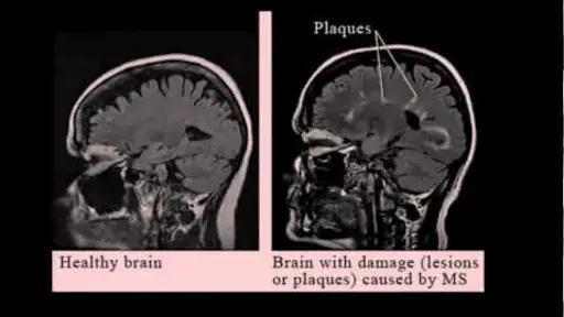 Filmy o stwardnieniu rozsianym: jak zrozumieć chorobę i jej wpływ na życie