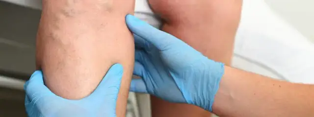 Niewydolność zastawek żylnych - poznaj skuteczne metody leczenia w 2025