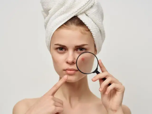 Trądzik? Moja rutyna krok po kroku do czystej cery!